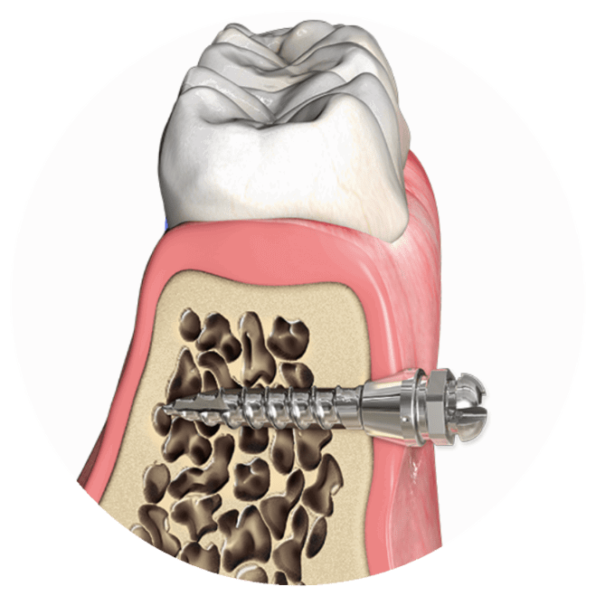 Microimplantes En Ortodoncia