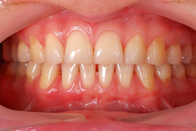 Penyakit Gusi Dari Gingivitis Hingga Periodontitis ISPMI Ikatan