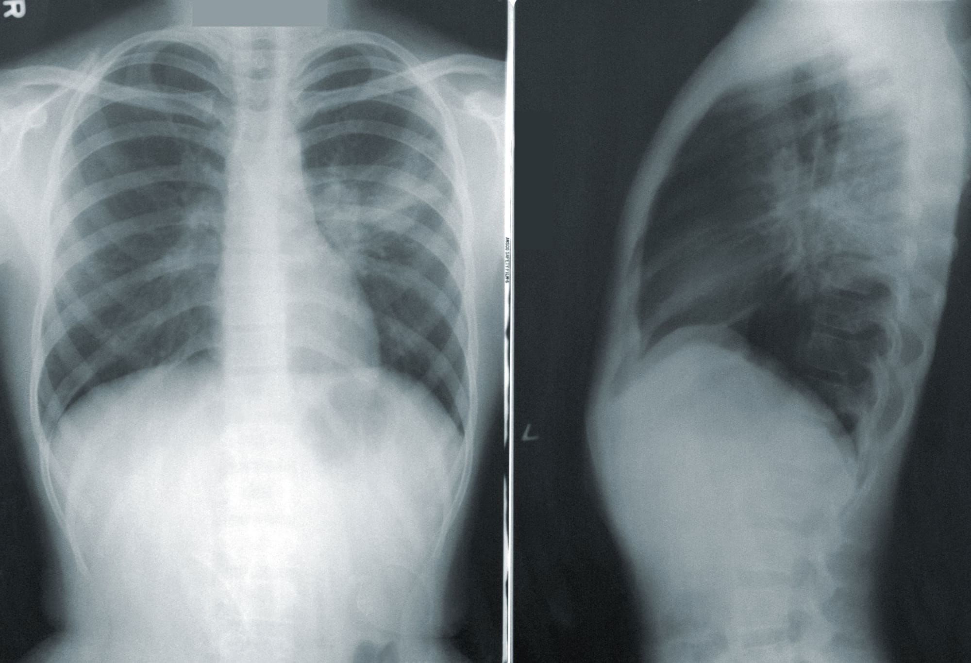 Latent tuberculosis and COVID-19 disease