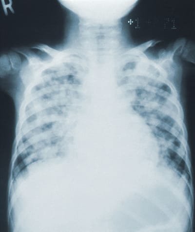 Lung Fibrosis image