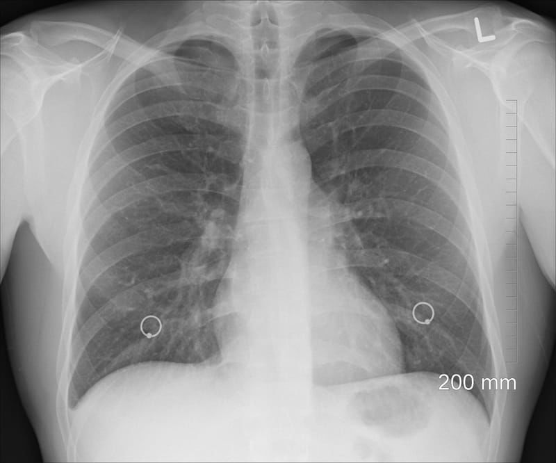 Lung Cancer Fostered by Air Pollution Without Mutating DNA