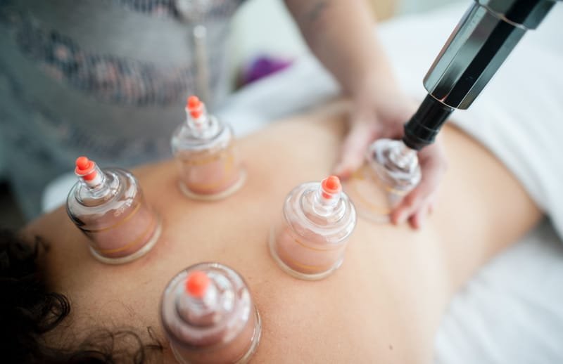 Cupping Therapy for Lymphatic Drainage and Cellulitis