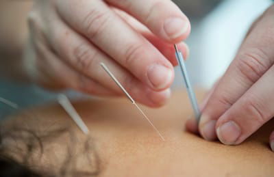 What's your benefit from dr Press's acupuncture? image