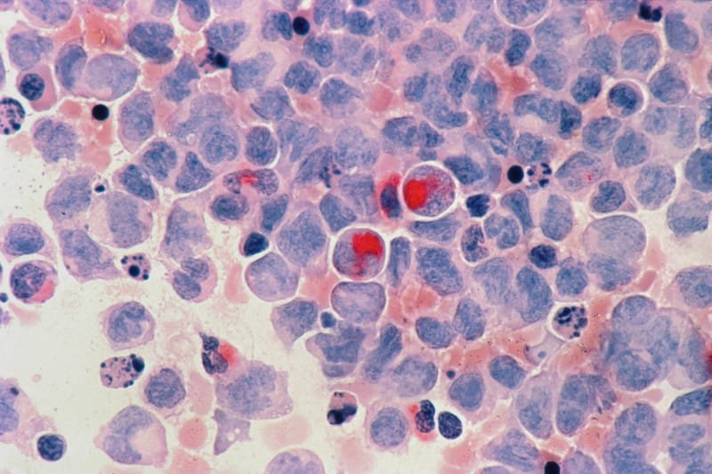 Cervix Cancer Screen-Human Papilloma Virus Test