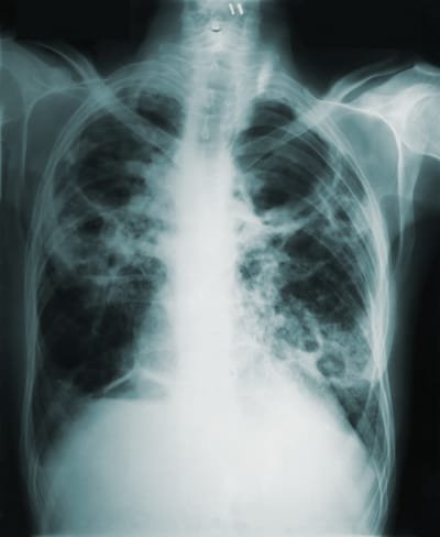 lung infections and Bronchiectasis image