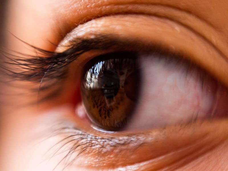 Déroulement d'un lasik