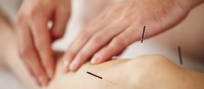 Application and Benefits of Acupuncture image