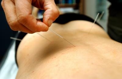 Health Benefits That You Can Obtain When You Employ Acupuncture for Treatment  image
