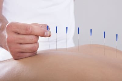 What are Some of the Benefits of Acupuncture? image