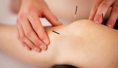 What You Can Gain From Acupuncture Treatment? image