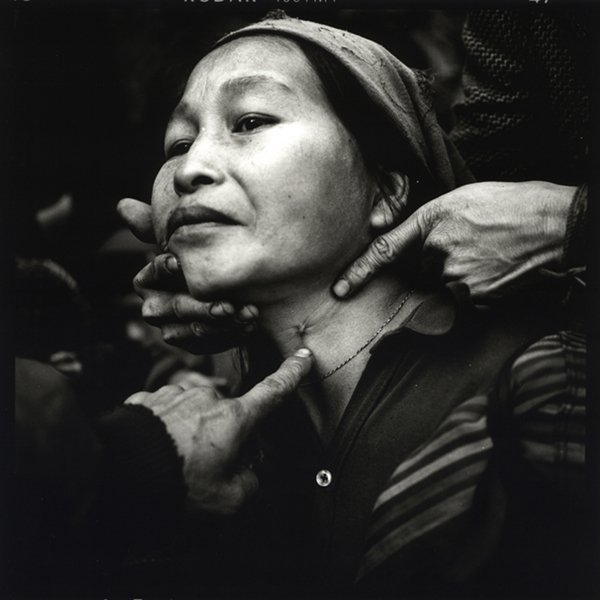 Philip Blenkinsop - Femme hmong blessée par les militaires laotiens, Laos 2003