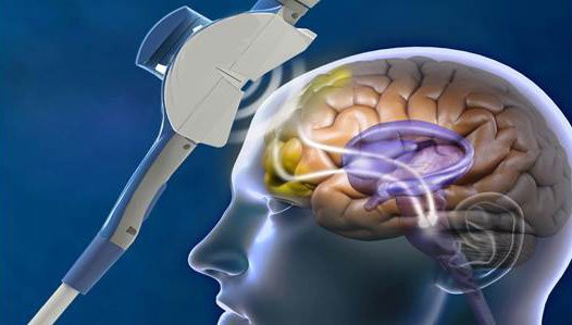 Transcranial Magnetic Stimulation vs. Neurofeedback – What Is The Best Choice For You?
