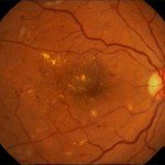 Colour Fundus Images of Healthy Persons & Patients with Diabetic Retinopathy