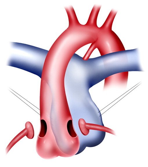 Arterial switch operation: simple, complex TGA, strategies, information needed, etc. Olivier Raisky, M3C-Necker