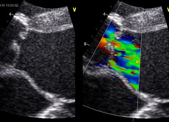 Will we face a big problem with the aortic valve after ASO? Laurence Iserin, M3C-HEGP