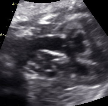 How to diagnose fetal tetralogy of Fallot ? - Bertrand Stos