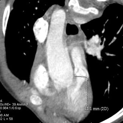 MR and CT after Tetralogy of Fallot repair - Elie Mousseaux