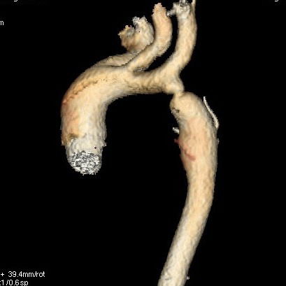 Non invasive anatomy and physiology in neonatal coarctation - Damien Bonnet