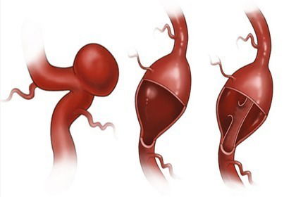 Long term outcomes after coarctation repair in infancy - Damien Bonnet