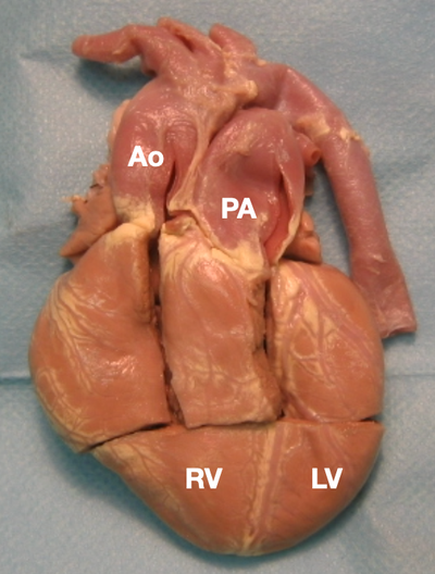 Anatomie morphologique des cardiopathies congénitales S1 2023 image
