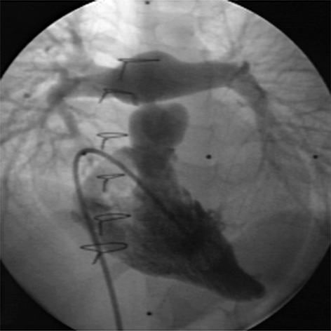 Cerclage de l'artère pulmonaire dans les cardiomyopathies dilatées