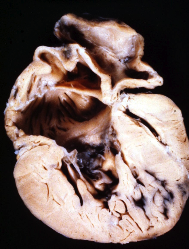 Anatomie morphologique des Cardiopathies congénitales-Fallot