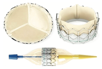 Reconstruction percutanée des bifurcations pulmonaires après chirurgie des cardiopathies congénitales