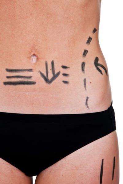 An Overview of Vaser Liposuction and its Advantages image