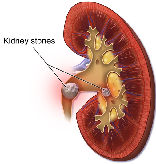Developing an indirect method for analyzing the composition of urinary stone