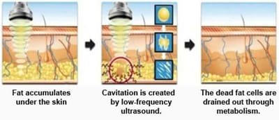 Cavitation Treatment Science image