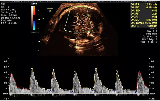 Doppler - Fluxometria Fetal