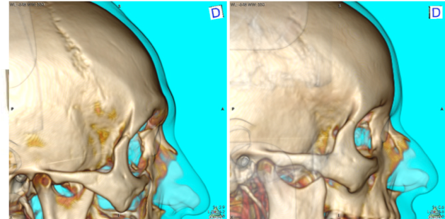 Cranioplastie fronto-orbitaire de féminisation