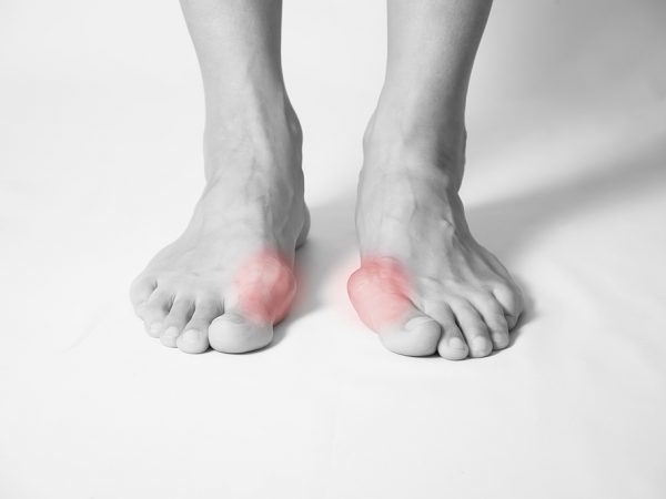 Hallux Valgus