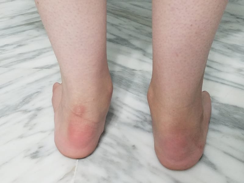 Foot And Ankle Deformities