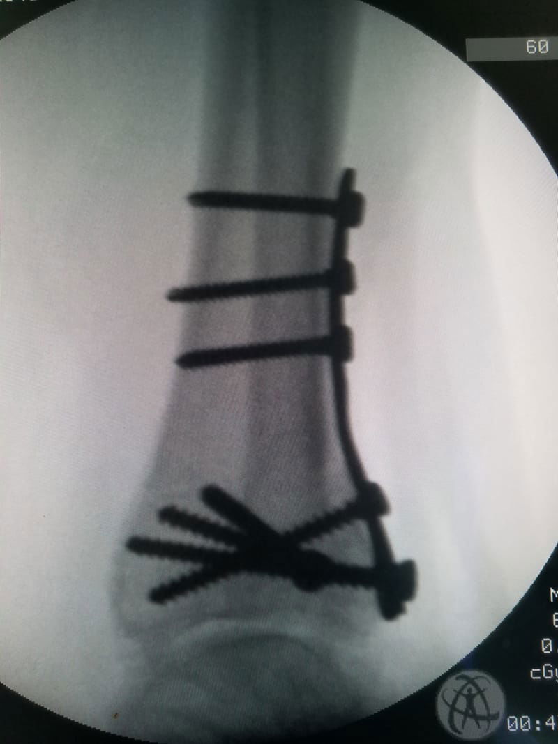 Foot and Ankle Fractures and Fracture Complications