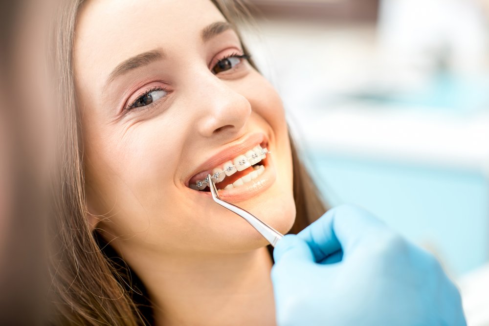 Hal Penting Dalam Pasang Kawat Gigi, Jangan Sampai tidak Tahu
