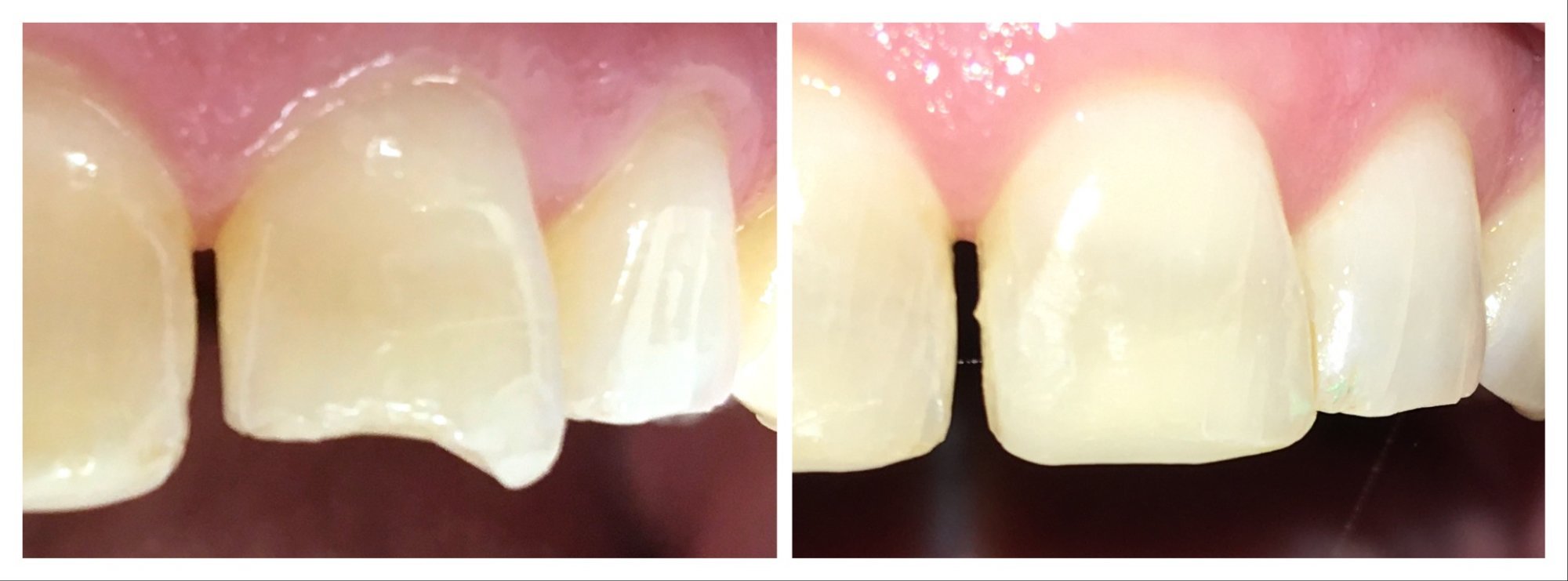 Tooth-Coloured Fillings