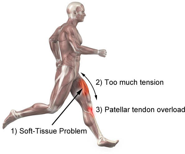 How to Treat Your Patellar Tendonitis Successfully