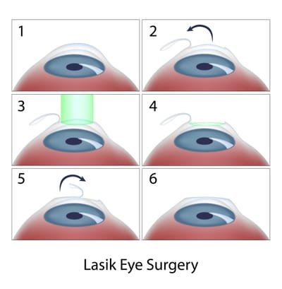 Refractive Surgery image