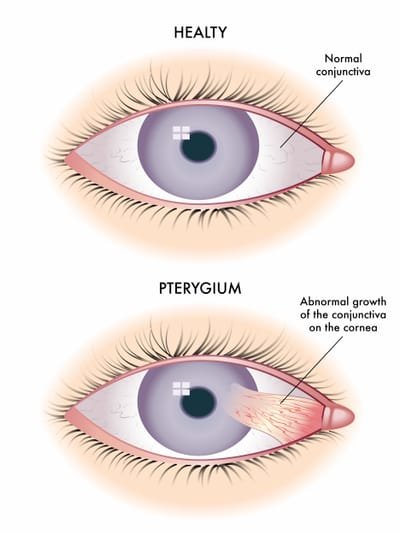 pterygium removal