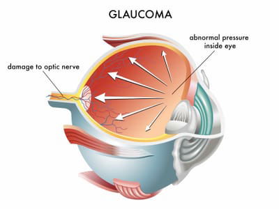 Glaucoma  image