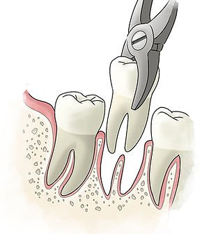  Tooth Extraction Upper East Side image