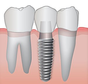 Dental Implant Upper East Side image