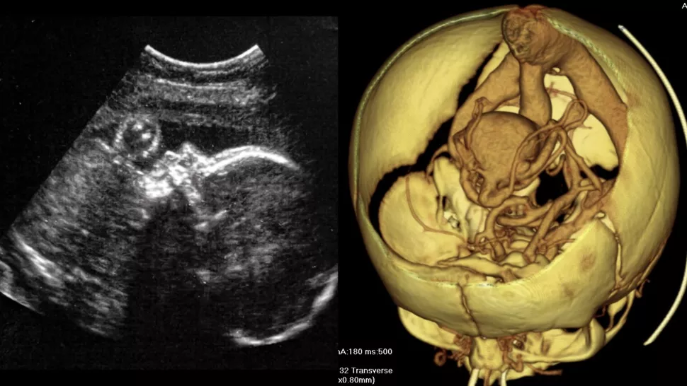 For those who claim a Fetus isn't a person. Doctors perform 1st-of-its-kind brain surgery on a fetus in the womb.