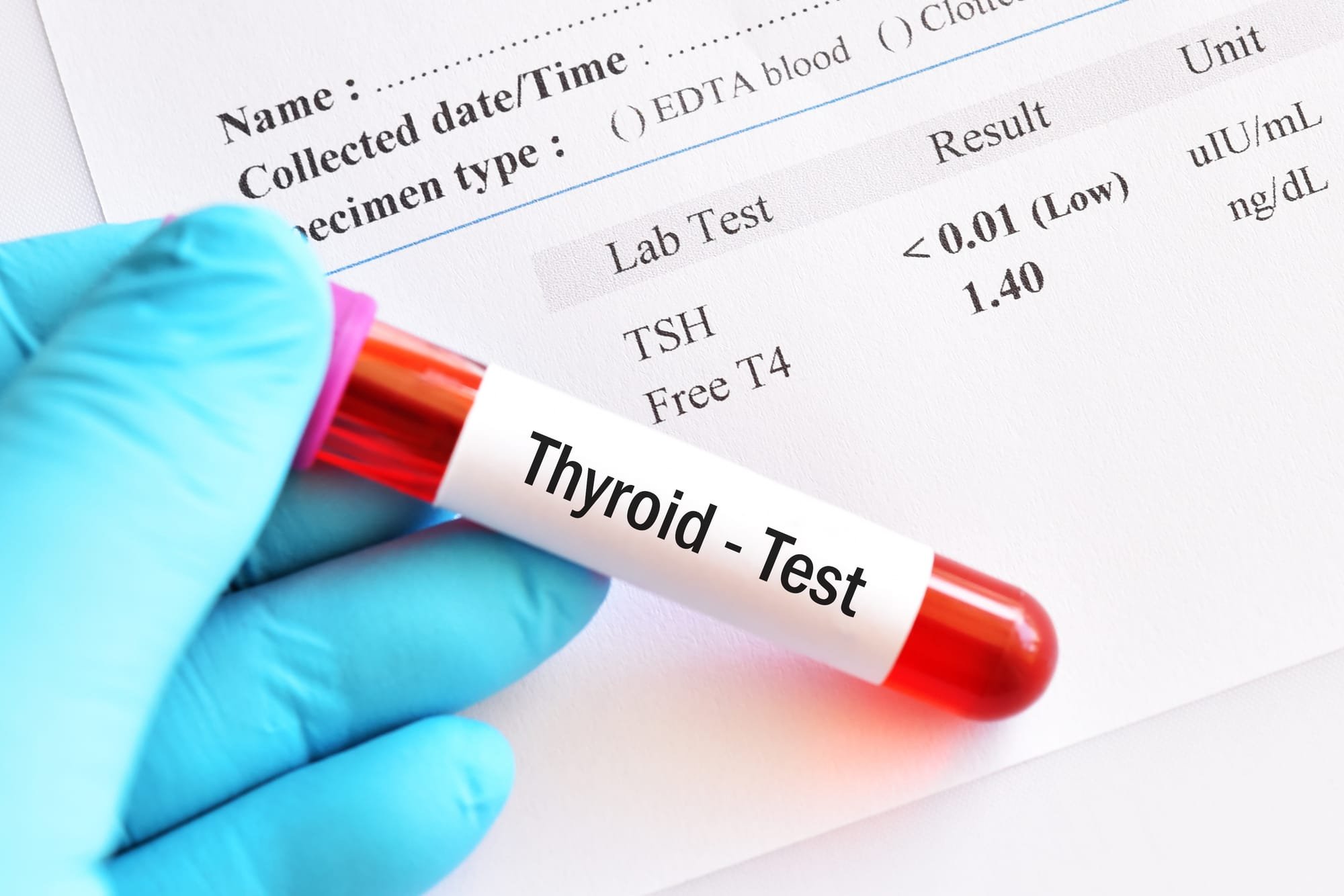 Why Is Your Thyroid Test Lying To You?