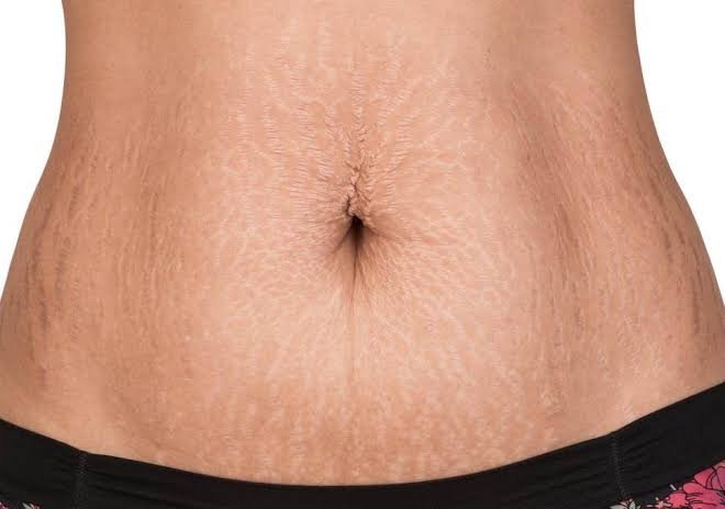 How to remove stretch marks on your body  ?