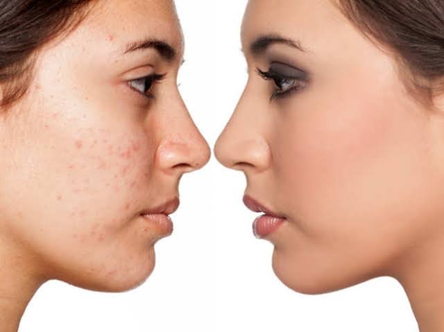 How to treat acne ?