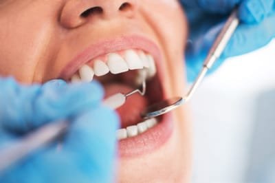 Factors that You Need to Consider Before Doing a Dental Implant image