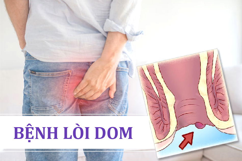 Tìm hiểu bệnh lòi dom có nguy hiểm không?