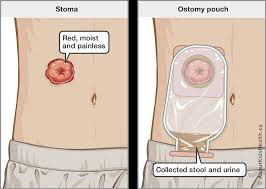 What is Ileostomy